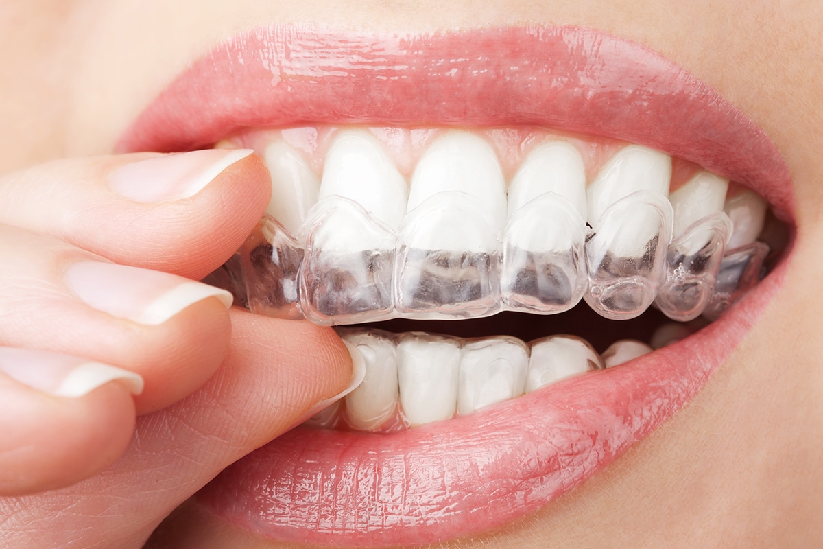 How Much Does Invisalign Teen Cost in Maplewood, NJ?